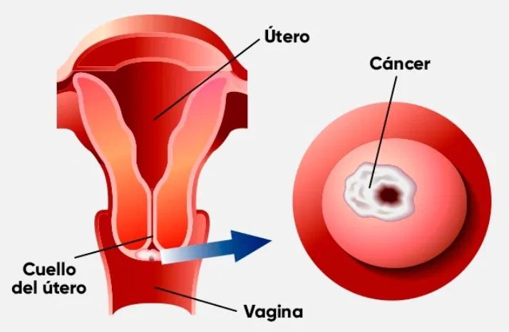 Prevención y tratamiento del cáncer de cuello uterino