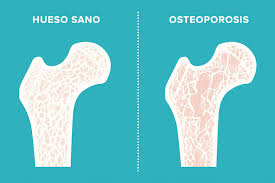 Recetas para prevenir la osteoporosis