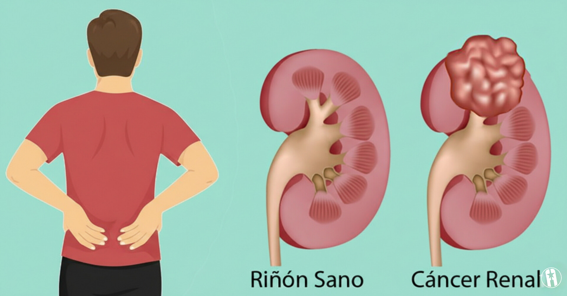 Cáncer de riñón